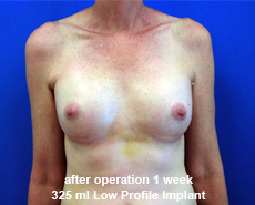 plastic-surgery-breast-augmentation